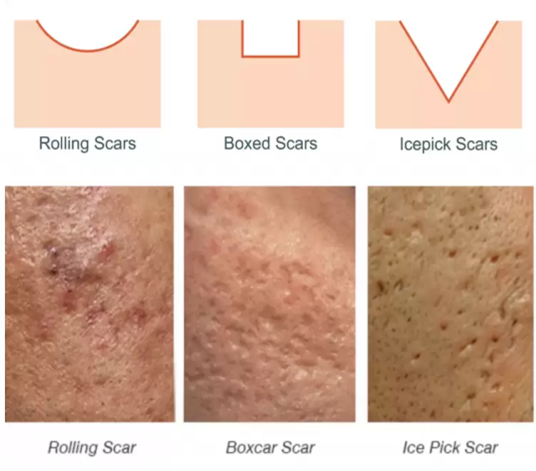 cicatrici_da_acne