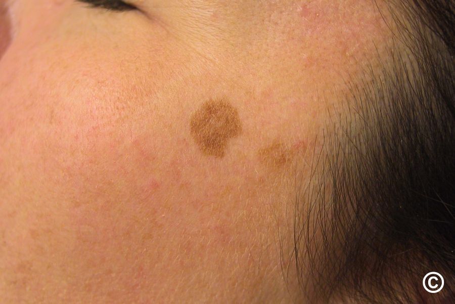 lentigo solar tipuri de pete pigmentare