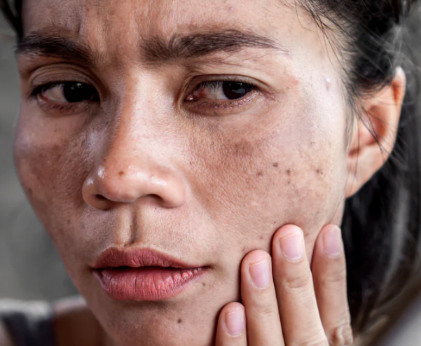 PIH - Pigmentare post inflamatorie tipuri de pete pigmentare