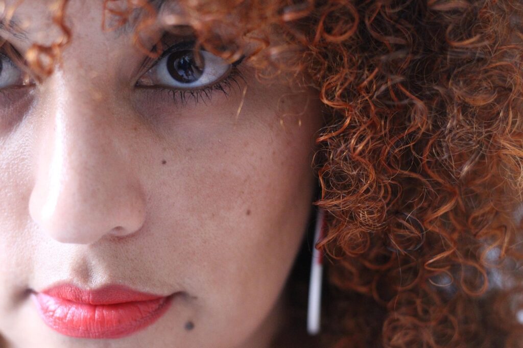 melasma tipuri de pete pigmentare